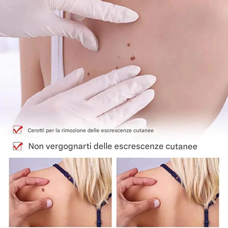 Rimozione di etichette e nei